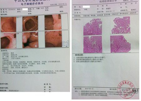溃疡性结肠炎会引起磨牙吗