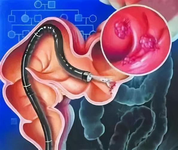 溃疡性结肠炎有不拉肚子吗