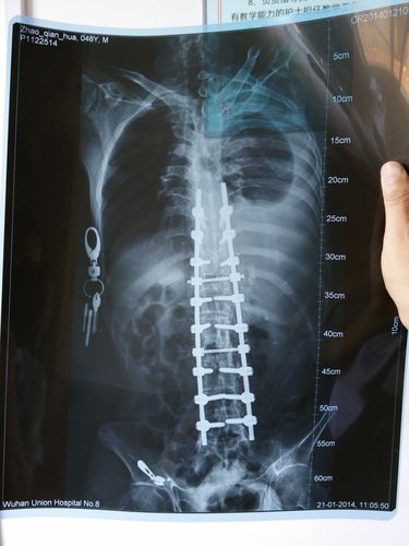 强直性脊柱炎发展到晚期得多久