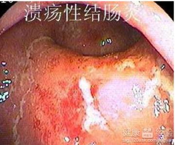 溃疡性结肠炎患者可以吃黄瓜吗