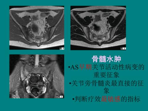 强直性脊柱炎后期心脏杂音