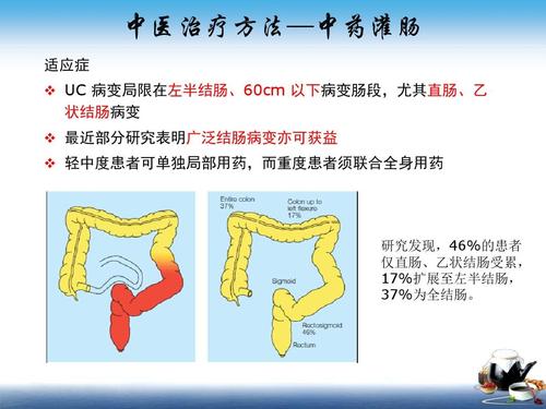 医院治疗溃疡性结肠炎