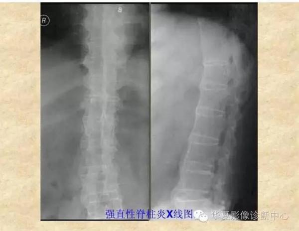 强直性脊柱炎能治好么