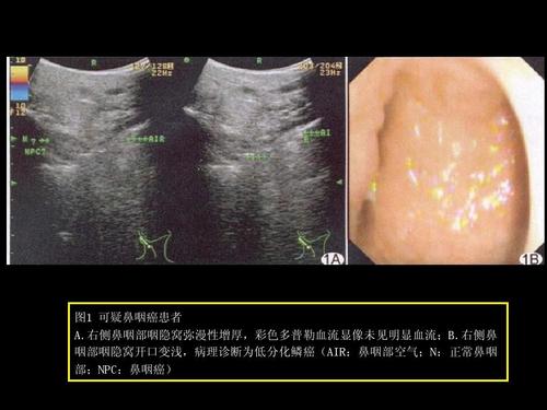 鼻咽癌