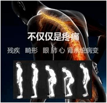 强直性脊柱炎哪里治疗