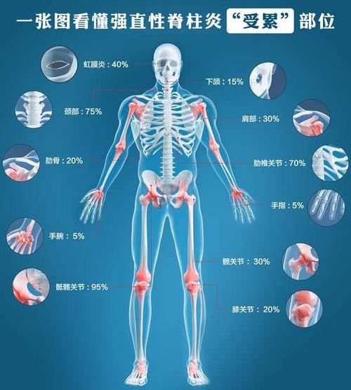 拉肚子会诱发强直性脊柱炎吗