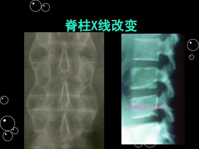 得了强直性脊柱炎