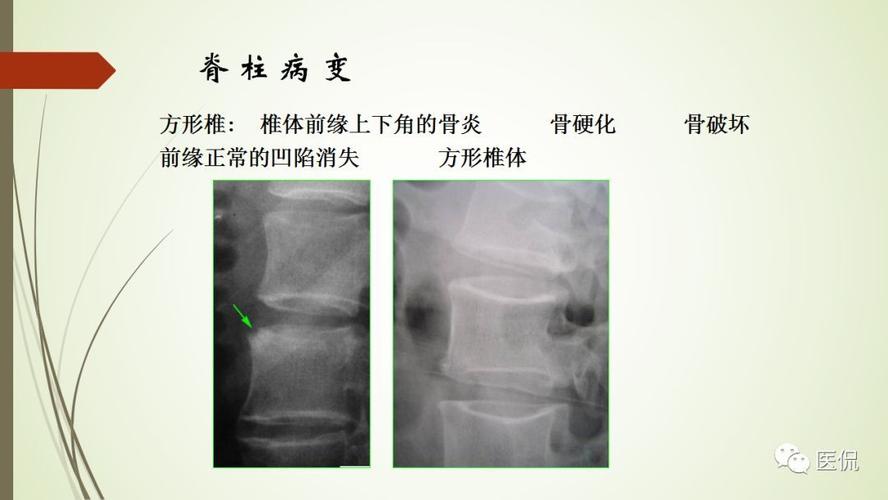 杭州做强直性脊柱炎ct多少钱