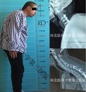 强直性脊柱炎怎么检查