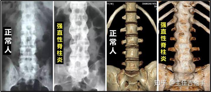 强直性脊柱炎寿命