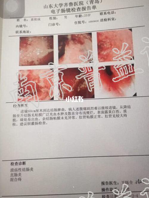 从风论治溃疡性结肠炎
