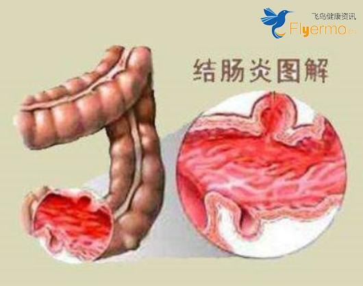 粪便治疗溃疡性结肠炎