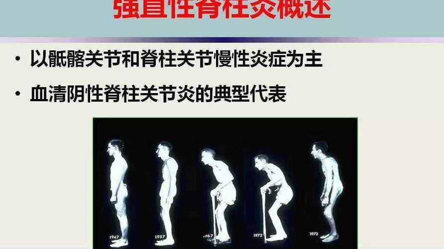渐冻症跟强直性脊柱炎一样吗