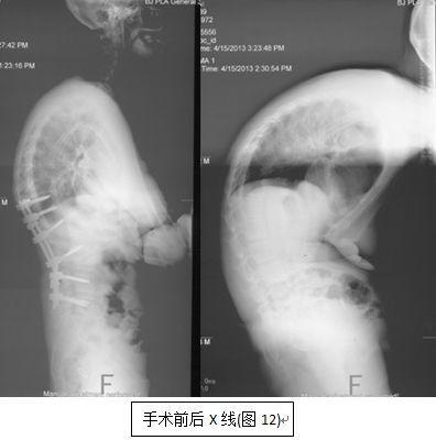 强直性脊柱炎x线2级