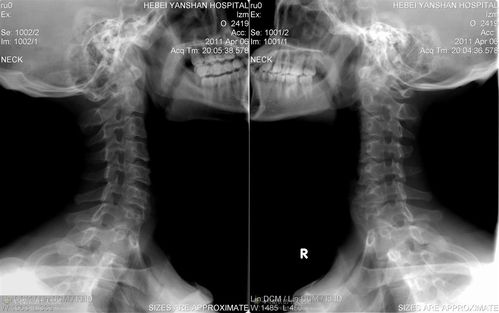 强直性脊柱炎一般首发部位是