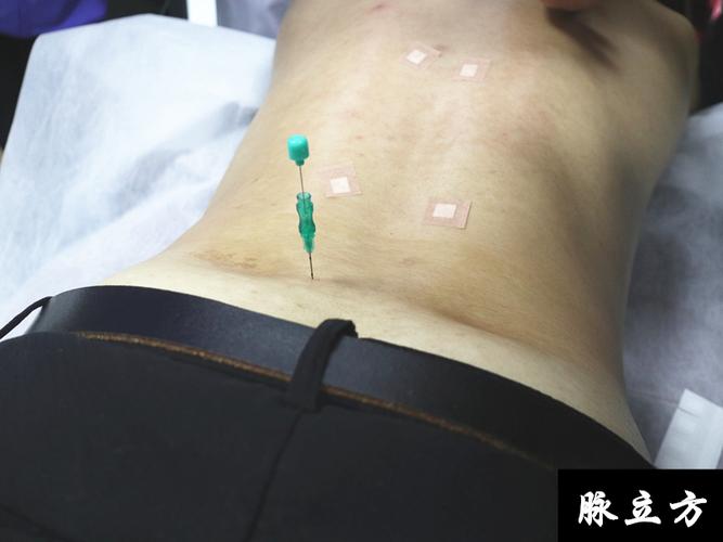 强直性脊柱炎中医针灸穴位
