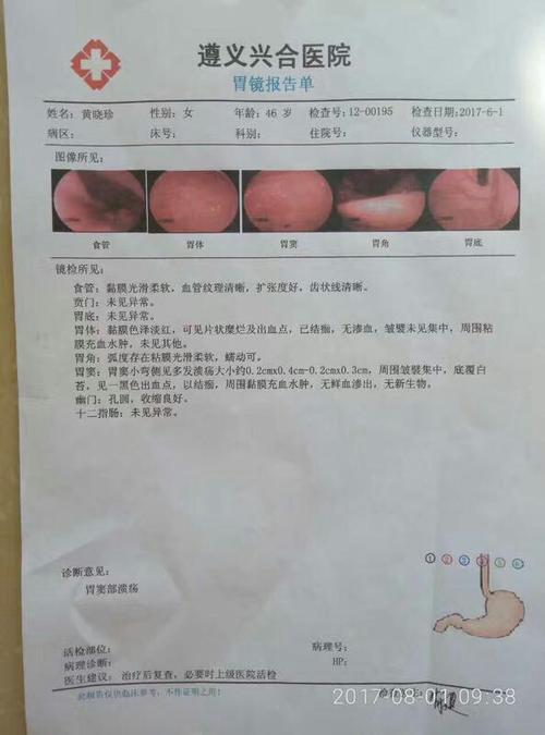 溃疡性结肠炎大便出血
