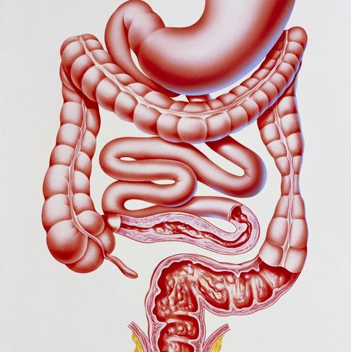 直肠型溃疡性结肠炎