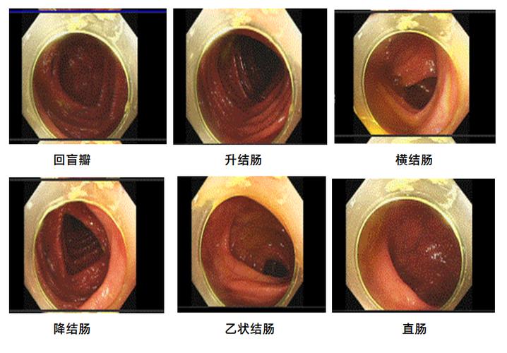 溃疡性结肠炎最新研究