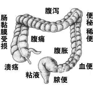 溃疡性结肠炎早期的8个症状