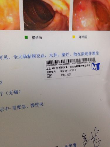 溃疡性结肠炎常出现什么粪便