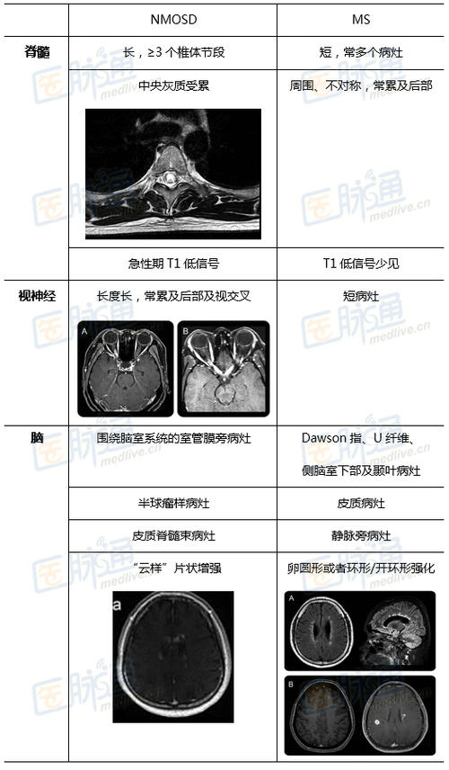 视神经脊髓炎