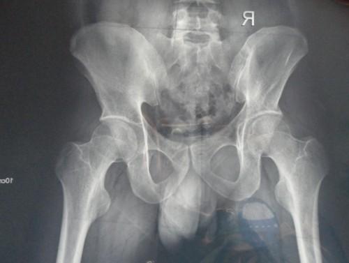强直性脊柱炎优生