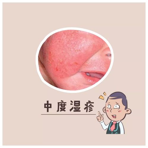 湿疹