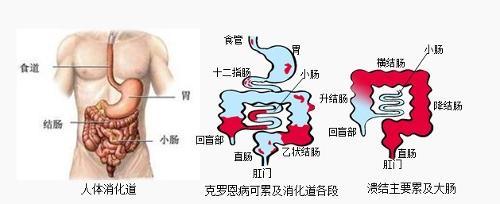 溃疡性结肠炎对身体危害