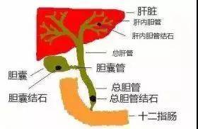 肝内胆汁淤积症