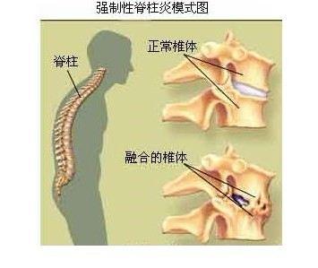 强直性脊柱炎能打太极
