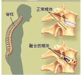 强直性脊柱炎病人步伐