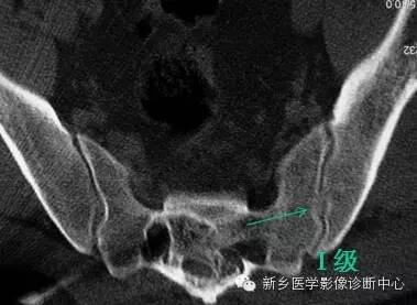 强直性脊柱炎能引起骨质硬化么