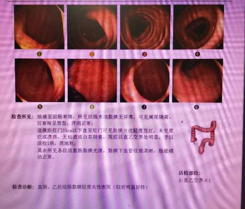 溃疡性结肠炎医院怎么检查