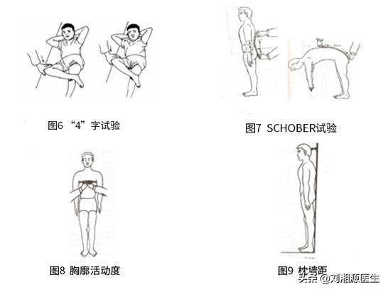 早期发现强直性脊柱炎该怎么办