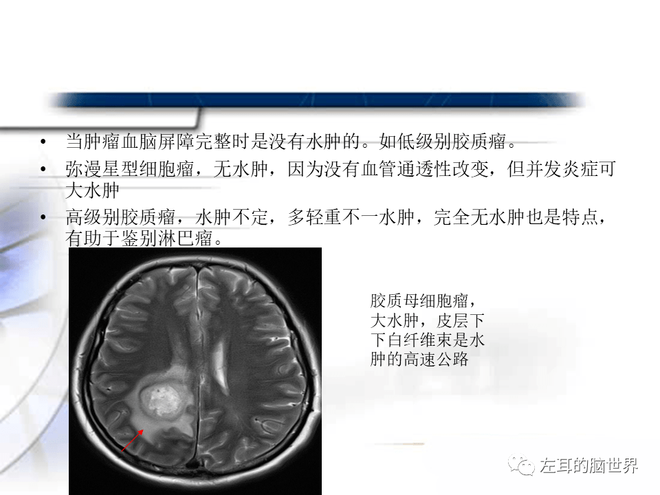 贝伐珠单抗4个月后赠药_胶质母细胞瘤脑水肿打贝伐单抗_贝伐珠单抗价格