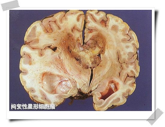 贝伐单抗多久有耐药性_胶质母瘤四级死亡过程_胶质母细胞瘤脑水肿打贝伐单抗