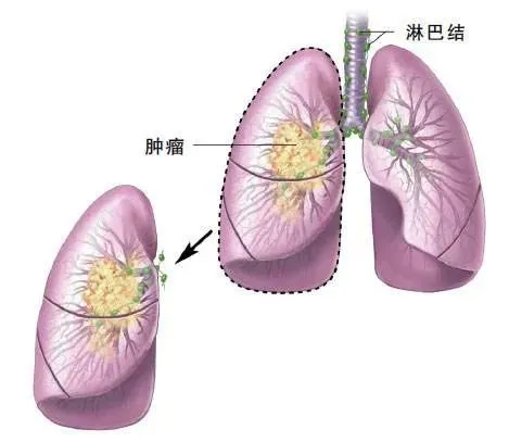 肺腺癌中期术后奥希替尼_甲磺酸奥希替尼片_去哪买印度版奥希替尼