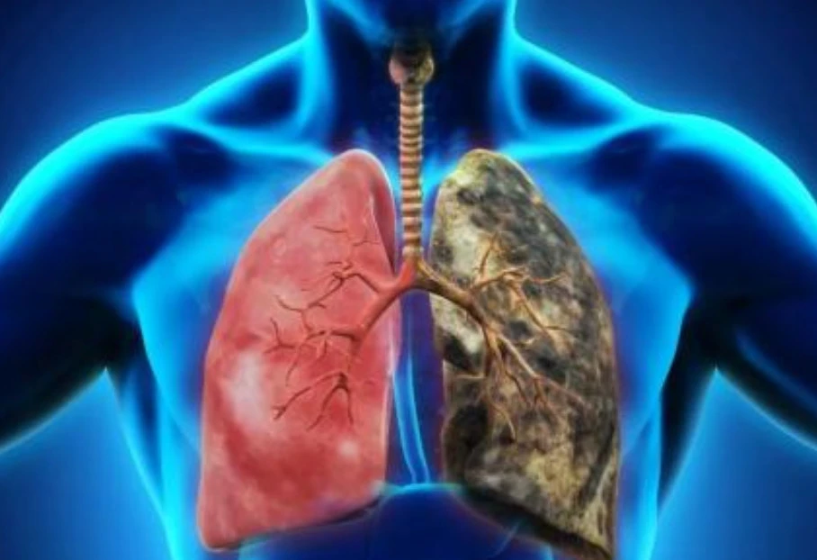 左肺IV期19突变，肺癌患者的一丝精准化治疗