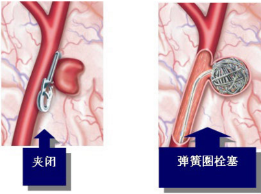 贝伐单抗能治好直肠癌_贝伐单抗肠癌适应症_西妥昔单抗贝伐单抗