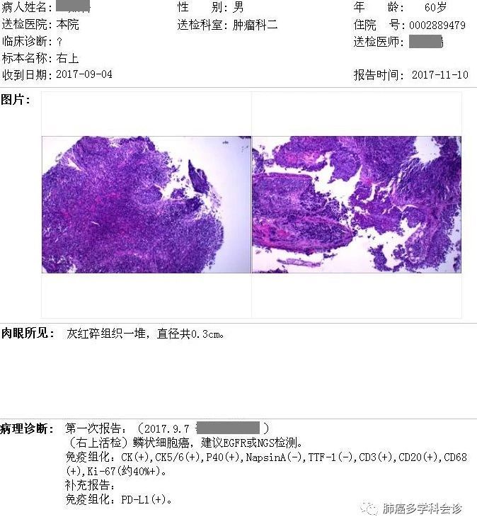 奥希替尼9291哪里买_去哪买印度版奥希替尼_t790原发突变服用奥希替尼