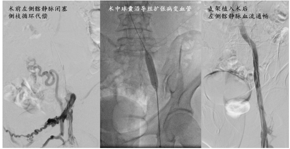 贝伐珠单抗多久用一次_贝伐珠单抗可以报销吗_罗氏贝伐珠单抗每次用几支
