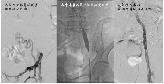 贝伐珠单抗的注射液活性成分及治疗单抗价格