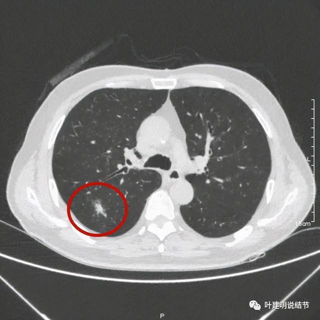 奥希替尼什么价格值得买？奥希替尼吃多久能痊愈？