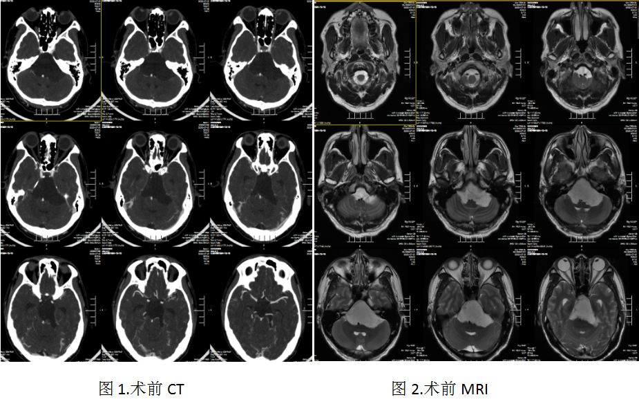 贝伐单抗对肺癌有用吗_头脑不清醒贝伐单抗有用吗_贝伐单抗-阿瓦斯汀大陆卖多少钱?