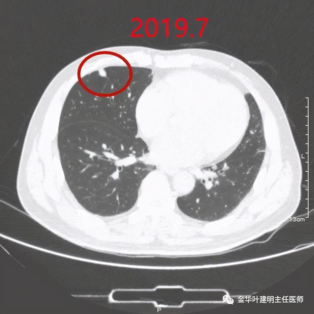 贝伐珠单抗注射液_贝伐珠单抗单药维持治疗肺腺癌_贝伐珠单抗 耐药性