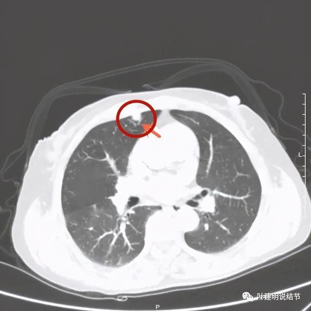 贝伐珠单抗注射液_贝伐珠单抗 耐药性_贝伐珠单抗单药维持治疗肺腺癌