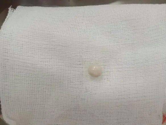 贝伐珠单抗不良反应_贝伐单抗术后辅助化疗_肺癌新药贝伐单抗