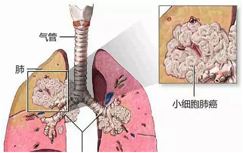 小细胞肺癌治疗新思路_好大夫在线极速李田单抗