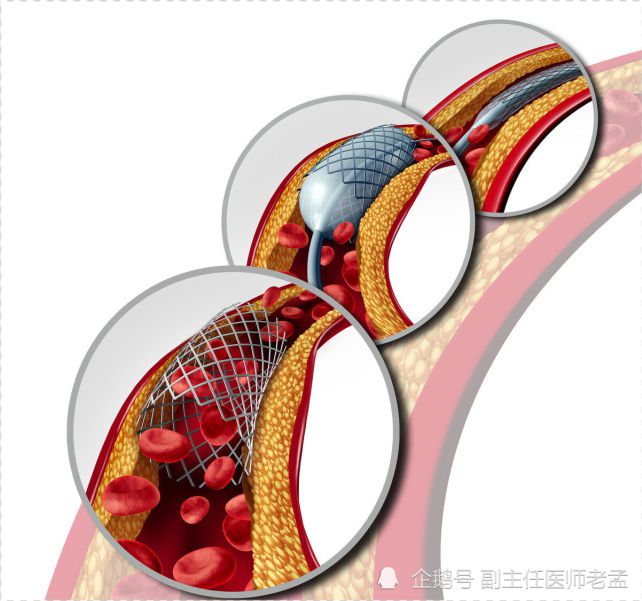 原发性尼靶向药，解决肝上病灶的肝腹水，值得收藏